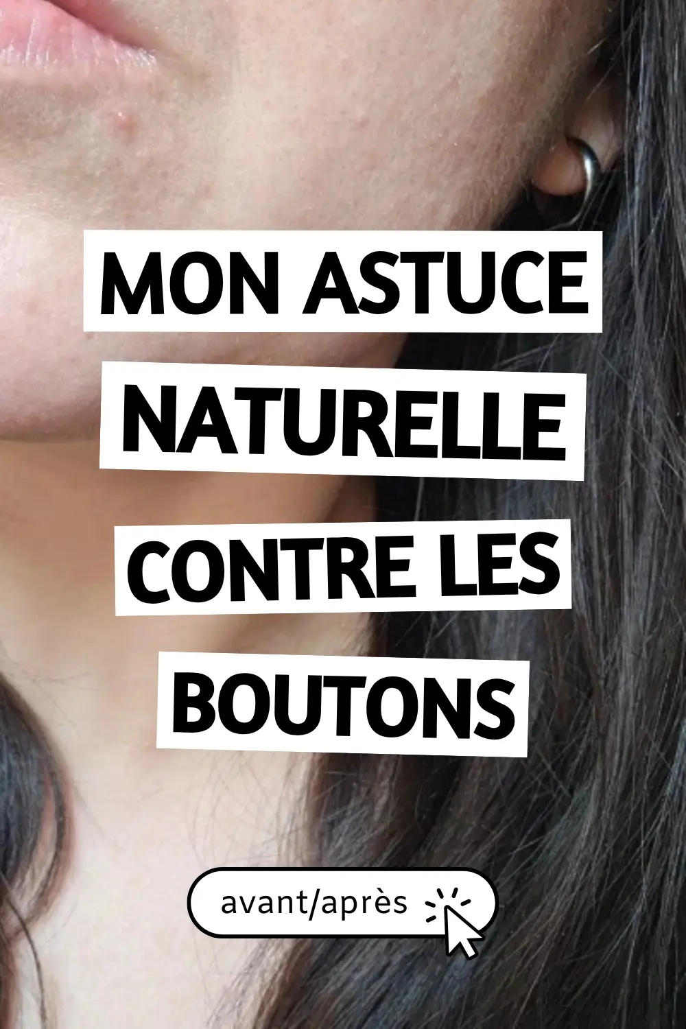 Mon astuce naturelle contre les boutons
