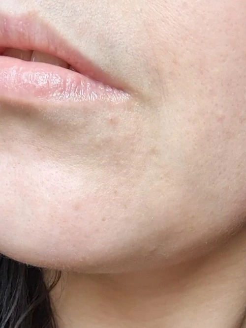 avant-apres-anti-boutons-neat-circles-apres