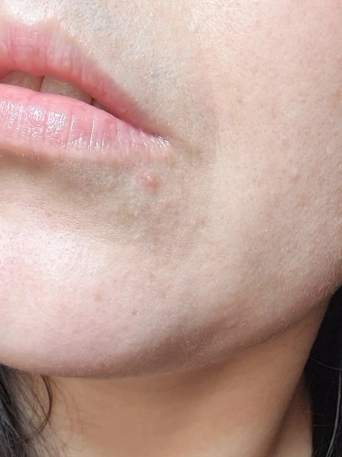 avant-apres-anti-boutons-neat-circles-avant