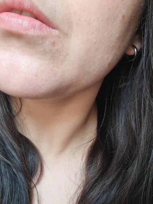 avant-apres-anti-imperfections-neat-circles-avant