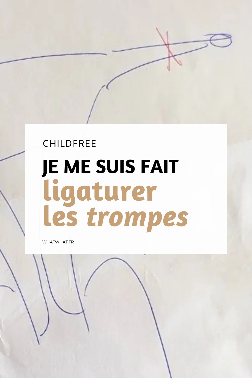 Childfree je me suis fait ligaturer les trompes