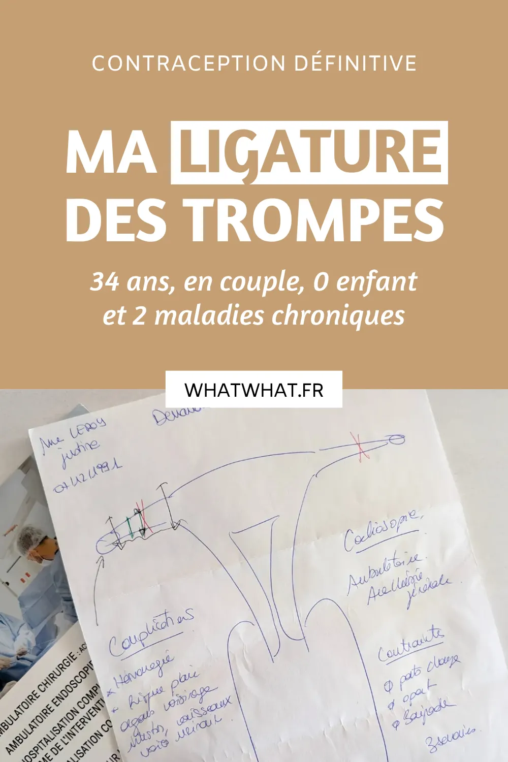 Ma ligature des trompes
