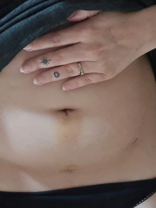 ligature-des-trompes-cicatrices-1-jours-post-op
