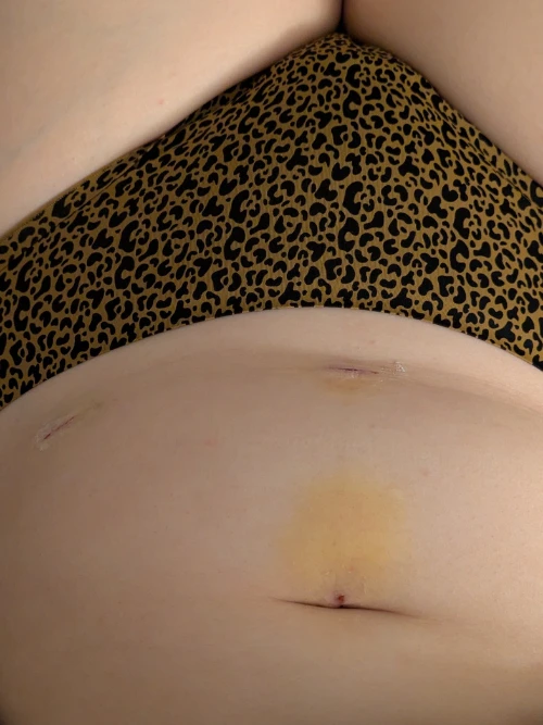 ligature-des-trompes-cicatrices-2-jours-post-op